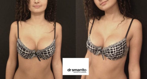 Augmentation Mammaire Lausanne Sur Mesure