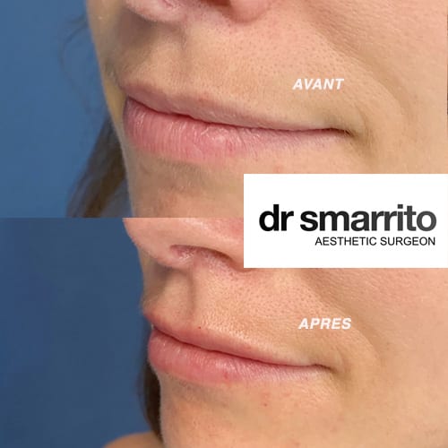 Avant et après injection des lèvres à l'acide hyaluronique – médecine esthétique Dr Smarrito