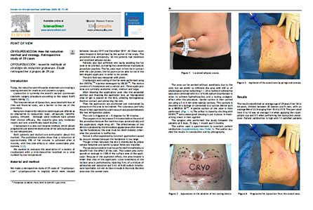 article cryoliposuccion
