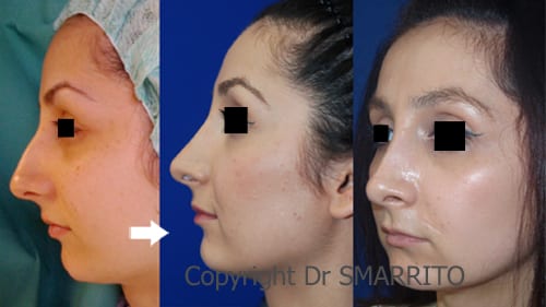 Avant et après rhinoplastie – chirurgie esthétique Dr Smarrito