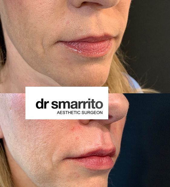 Avant et après injection des lèvres à l'acide hyaluronique – médecine esthétique Dr Smarrito