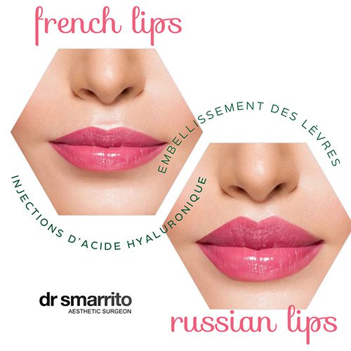 Injection des lèvres : Russian lips ou French lips ?