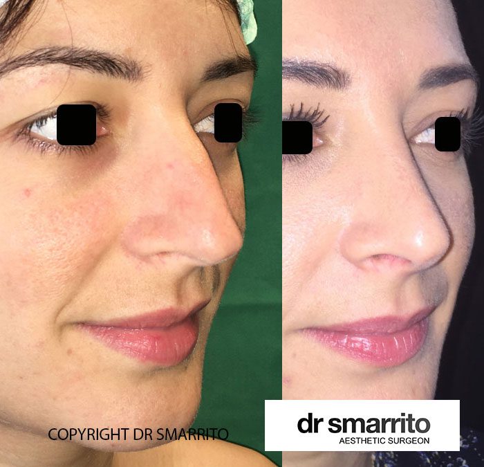 Avant et après rhinoplastie – chirurgie esthétique Dr Smarrito