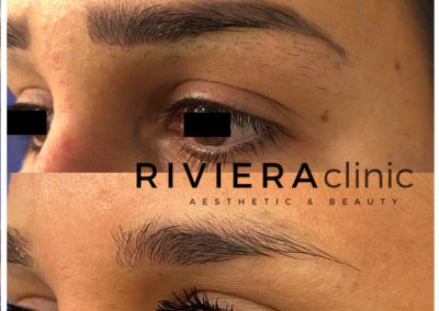 Détatouage des sourcils en 3 séances grâce au laser PICOSURE RIVIERAclinic