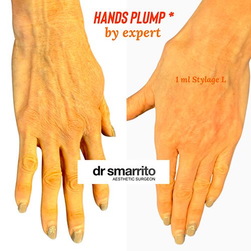 injection d'acide hyaluronique pour les mains