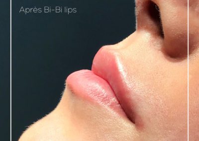 Injection d'acide hyaluronique selon la technique bi-bi lips