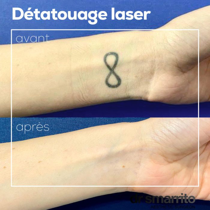 Détatouage laser Picosure