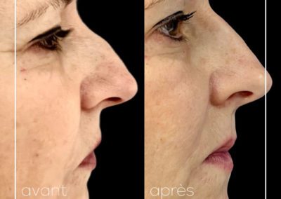Rhinoplastie médicale par injection d'acide hyaluronique