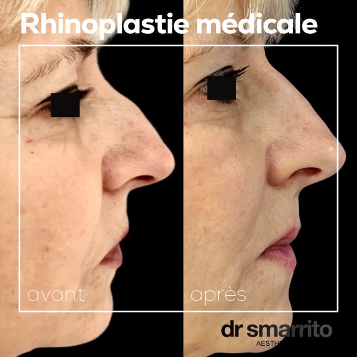 Avant et après rhinoplastie médicale – médecine esthétique Dr Smarrito