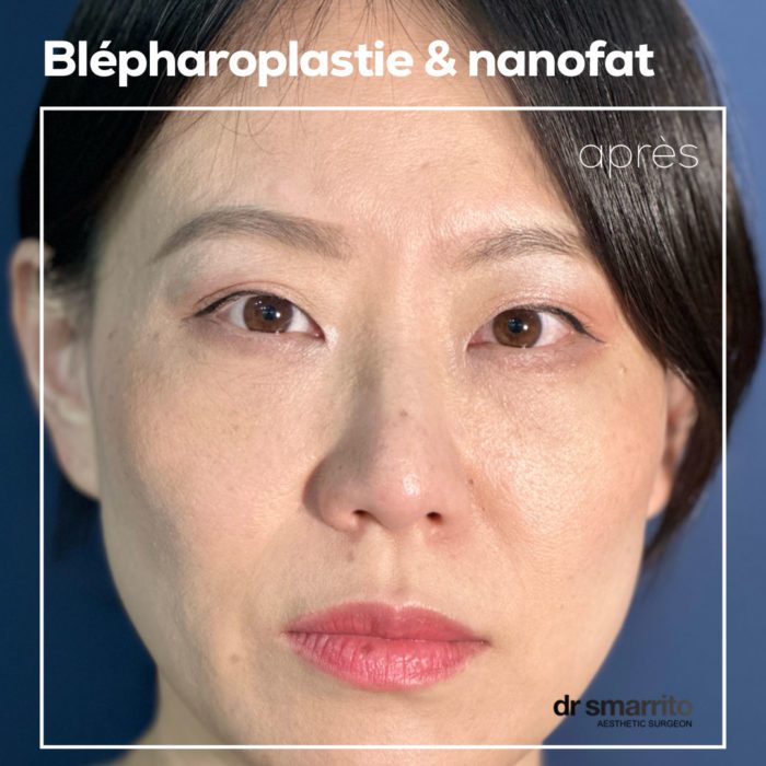 blépharoplastie et nanofat
