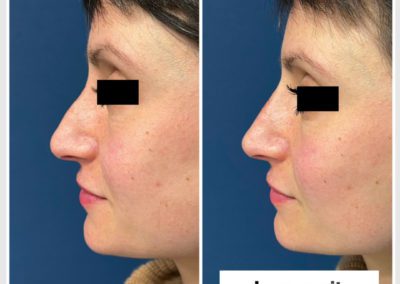 Rhinoplastie médicale par le docteur SMARRITO, une simple injection d'acide hyaluronique pour corriger en douceur la point et une légère bosse