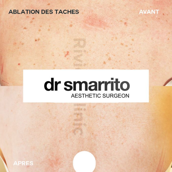 Enlever les taches brunes au laser – médecine esthétique Dr Smarrito