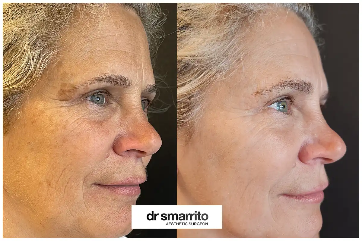Photorajeunissement – médecine esthétique Dr Smarrito