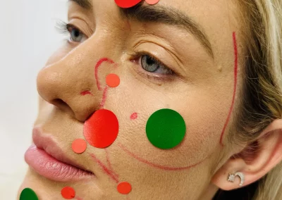 zones à risque lors des injections d'acide hyaluronique