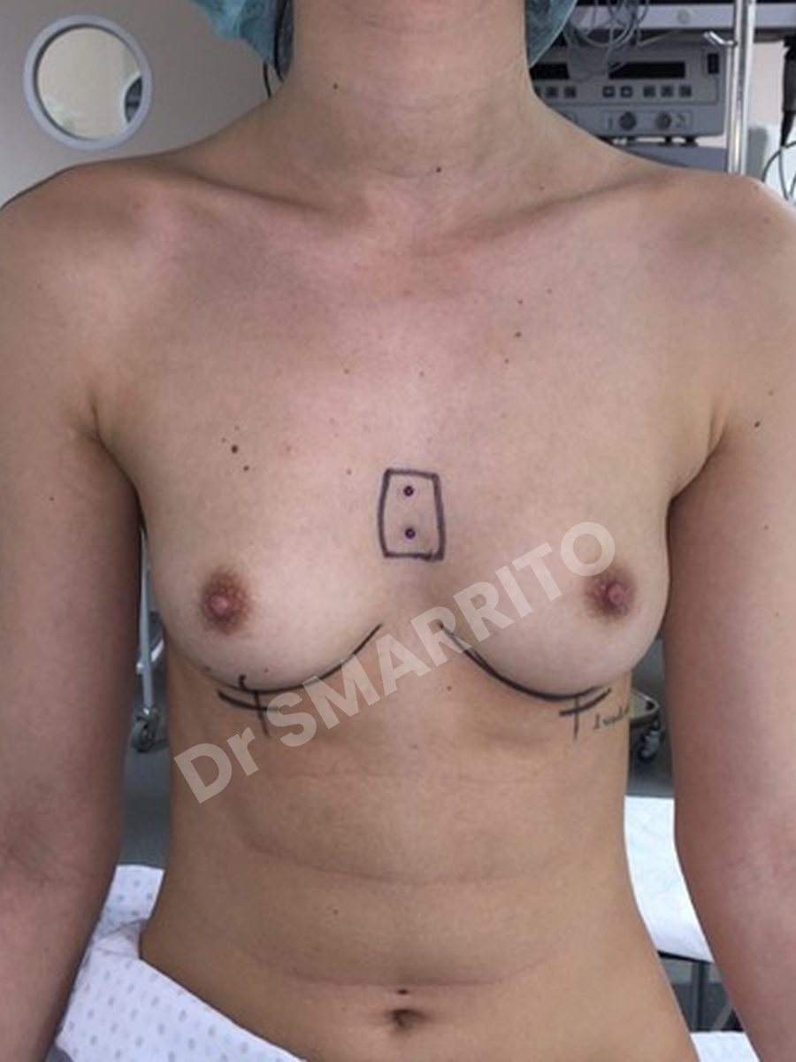 Augmentation mammaire avant : prothèses, vue de face, Dr Smarrito, chirurgie esthétique à Vevey