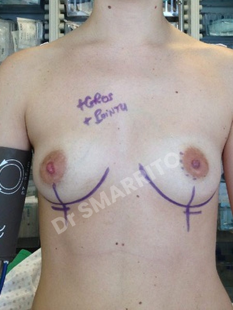 Augmentation mammaire avant : prothèses, vue de face, Dr Smarrito, chirurgie esthétique à Vevey