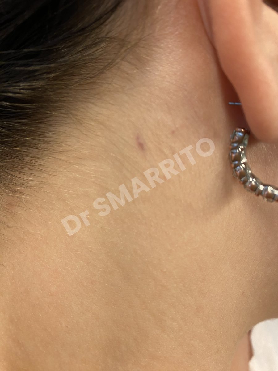 Détatouage laser après : encre rouge, trait fin, Dr Smarrito, chirurgie esthétique et laser à Vevey