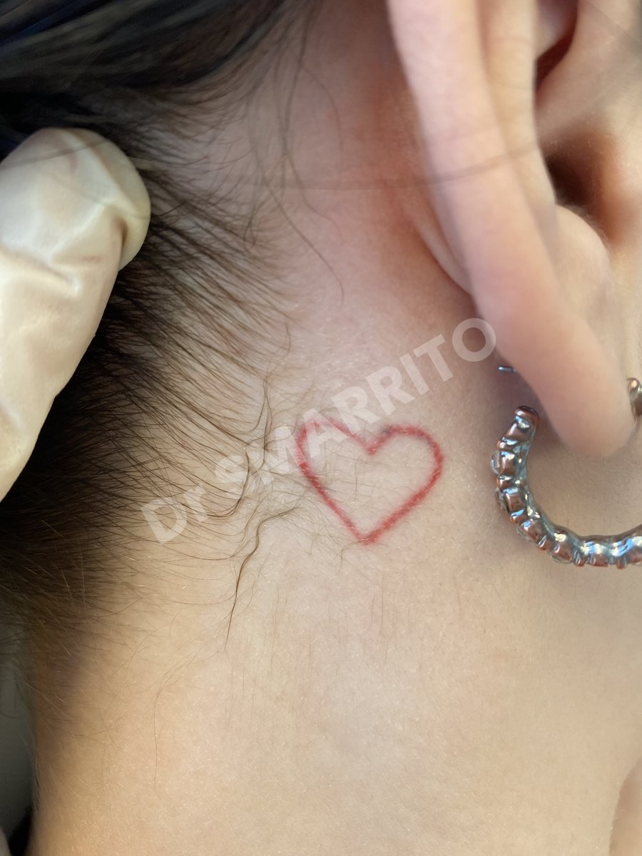 Détatouage laser avant : encre rouge, trait fin, Dr Smarrito, chirurgie esthétique et laser à Vevey