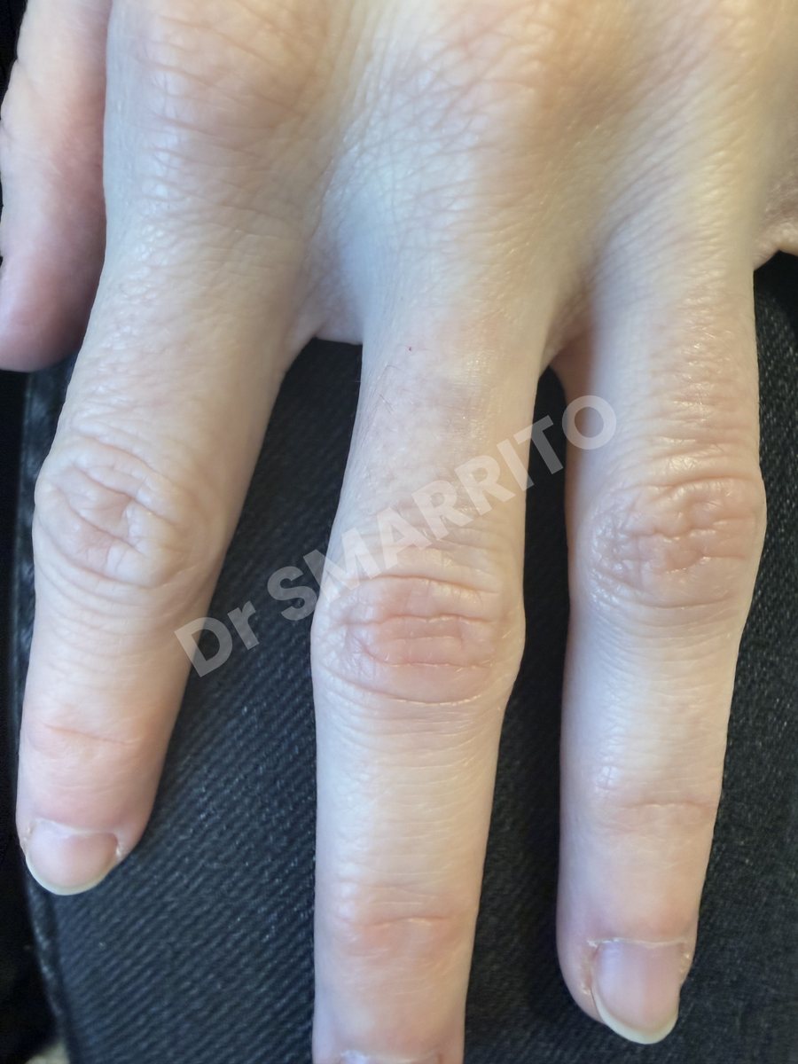 Détatouage laser après : encre noire, trait fin, peu d'encre, Dr Smarrito, chirurgie esthétique et laser à Vevey