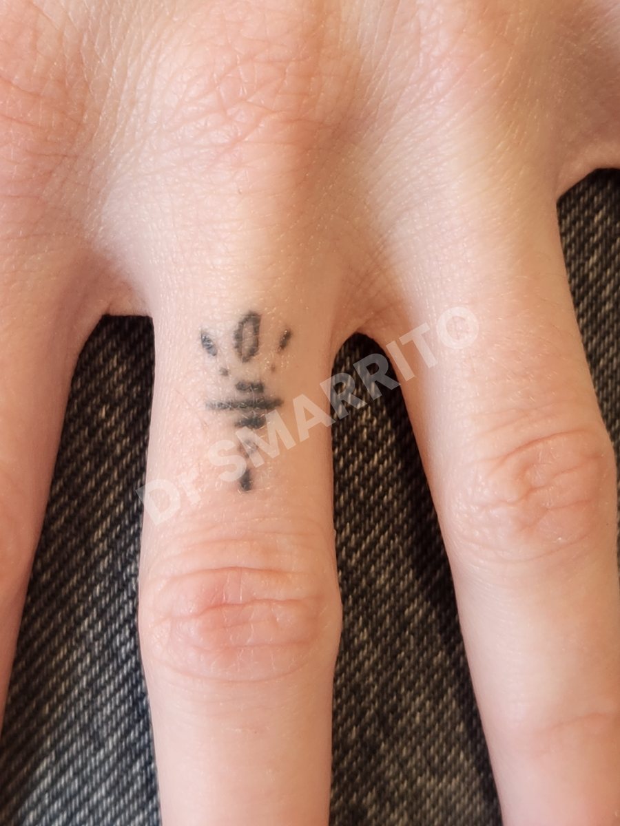 Détatouage laser avant : encre noire, trait fin, peu d'encre, Dr Smarrito, chirurgie esthétique et laser à Vevey