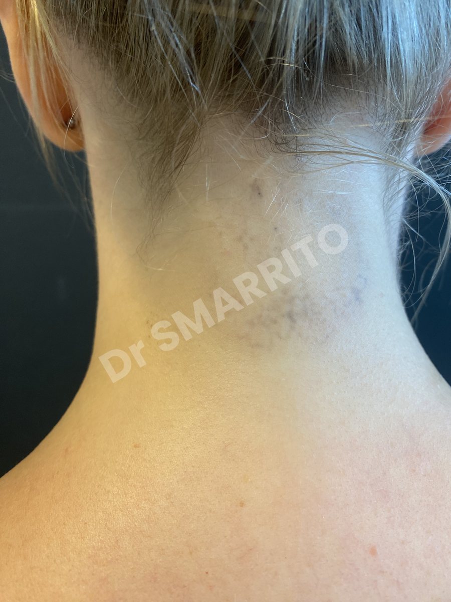Détatouage laser après : encre noire, traits fins et ombrages, Dr Smarrito, chirurgie esthétique et laser à Vevey