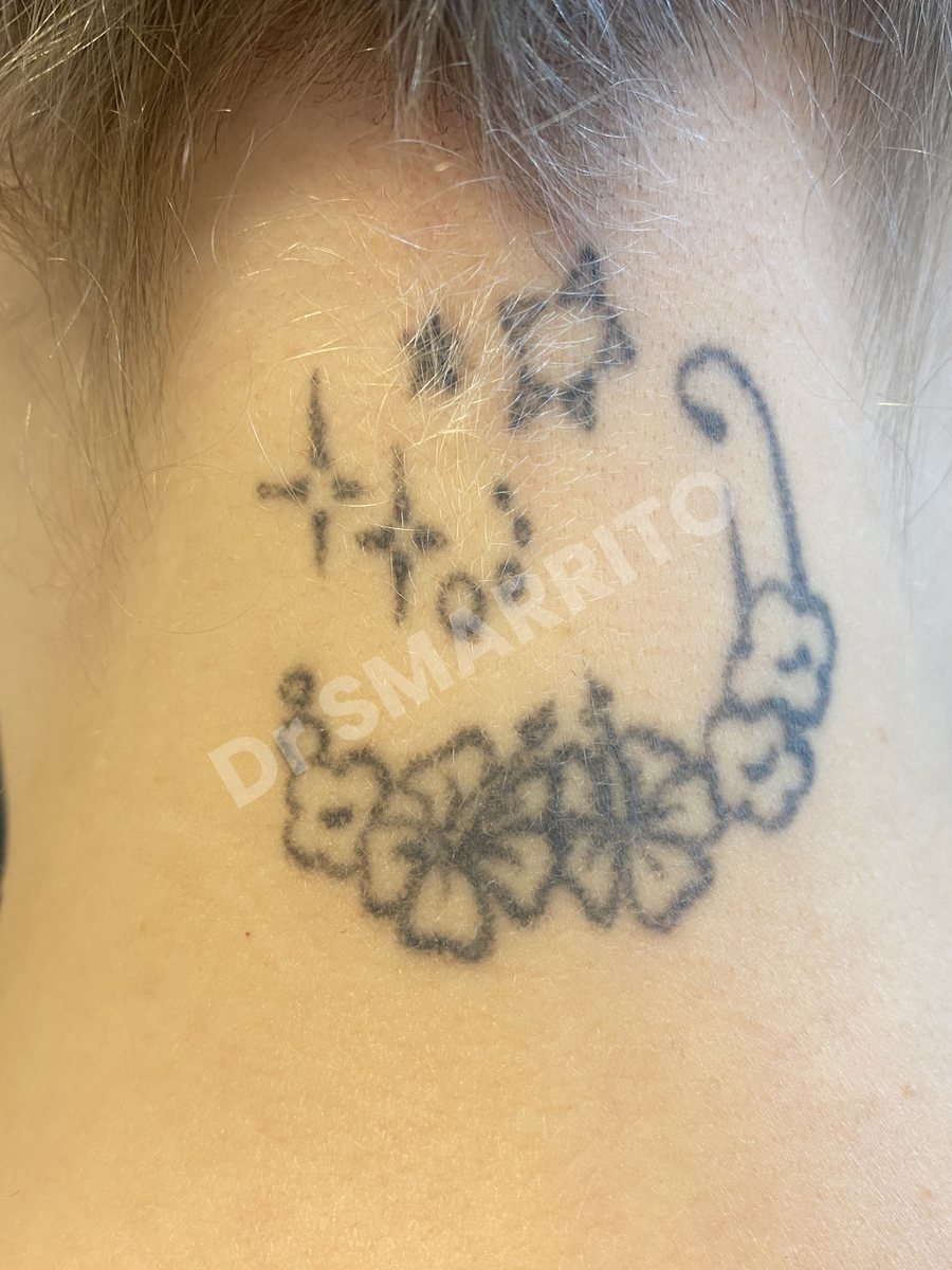 Détatouage laser avant : encre noire, traits fins et ombrages, Dr Smarrito, chirurgie esthétique et laser à Vevey