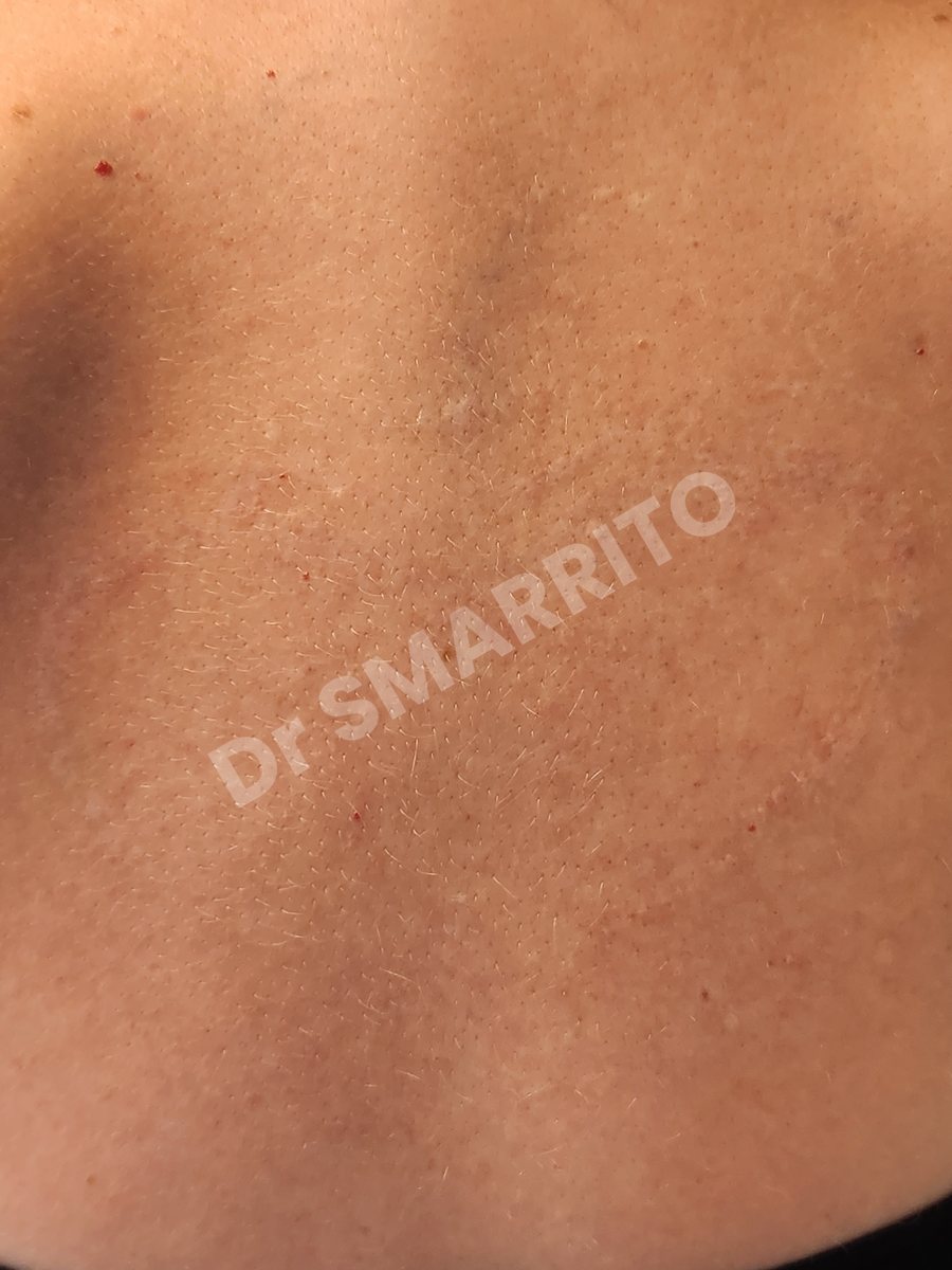 Détatouage laser après : encre noire dense, trait épais, Dr Smarrito, chirurgie esthétique et laser à Vevey