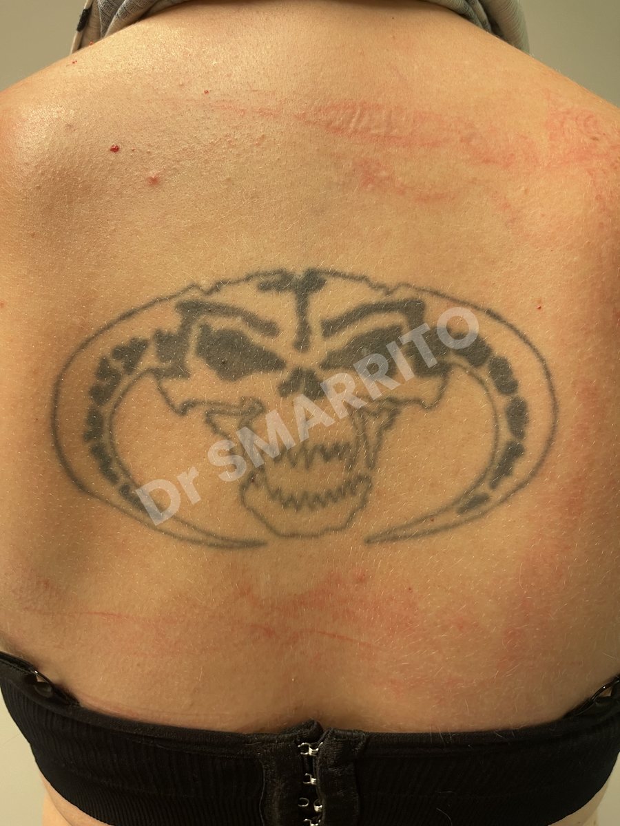 Détatouage laser avant : encre noire dense, trait épais, Dr Smarrito, chirurgie esthétique et laser à Vevey