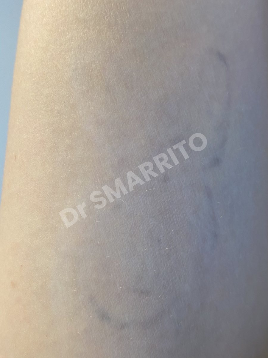 Détatouage laser après : aplat d'encre noire, tatouage très chargé, Dr Smarrito, chirurgie esthétique et laser à Vevey