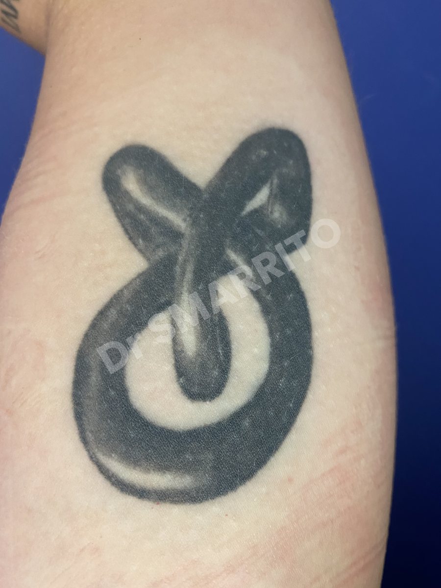 Détatouage laser avant : aplat d'encre noire, tatouage très chargé, Dr Smarrito, chirurgie esthétique et laser à Vevey