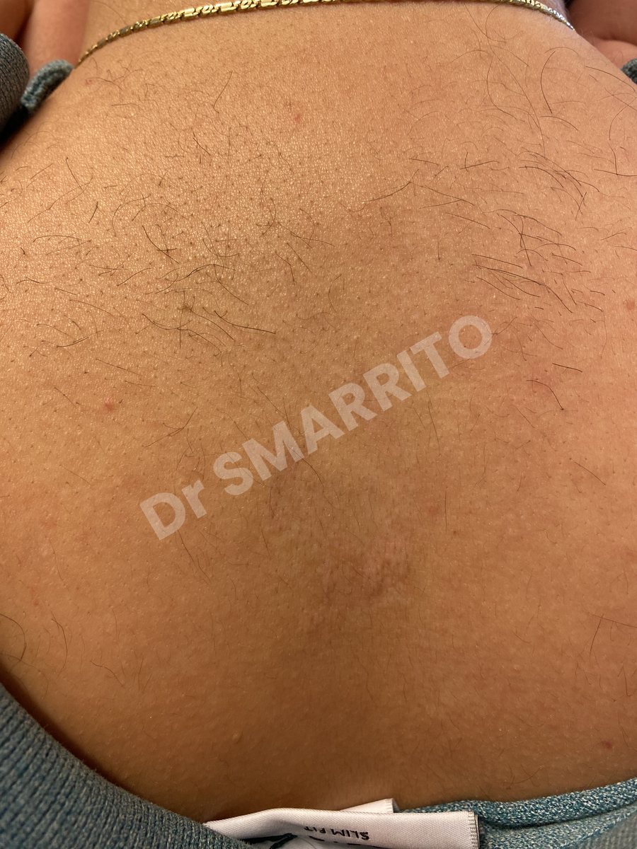 Détatouage laser après : aplat d'encre noire, tatouage chargé, Dr Smarrito, chirurgie esthétique et laser à Vevey