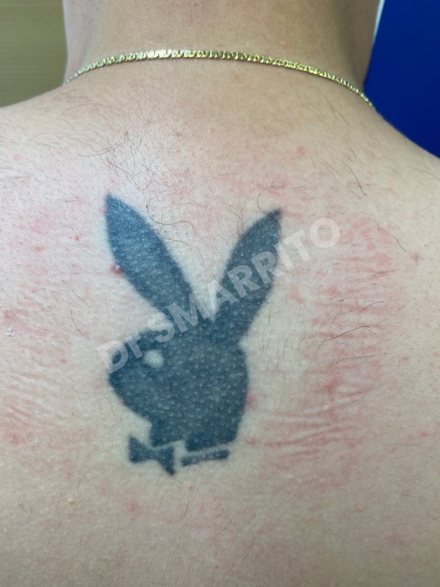 Détatouage laser avant : aplat d'encre noire, tatouage chargé, Dr Smarrito, chirurgie esthétique et laser à Vevey