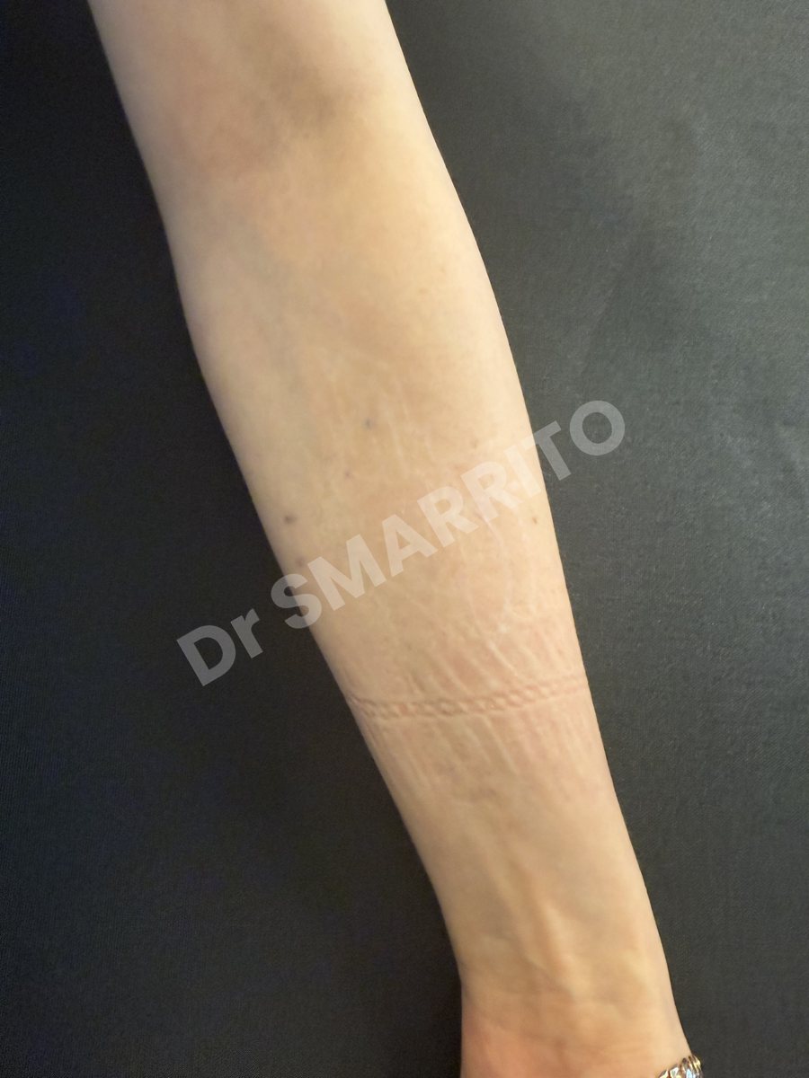 Détatouage laser après : encre noire, trait fin régulier, grande surface, Dr Smarrito, chirurgie esthétique et laser à Vevey