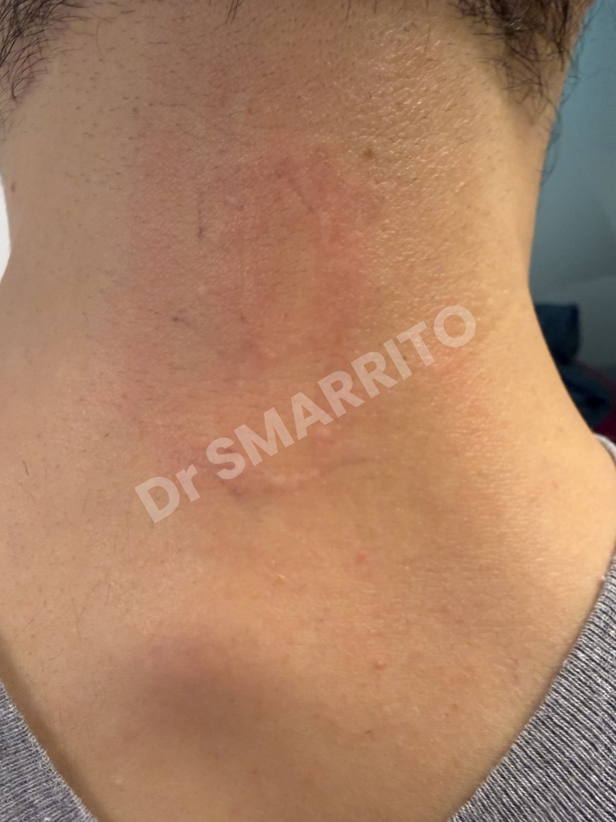 Détatouage laser après : aplat noir épais, encre profonde, Dr Smarrito, chirurgie esthétique et laser à Vevey