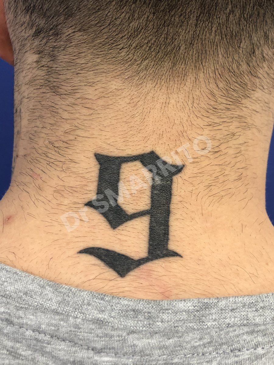 Détatouage laser avant : aplat noir épais, encre profonde, Dr Smarrito, chirurgie esthétique et laser à Vevey