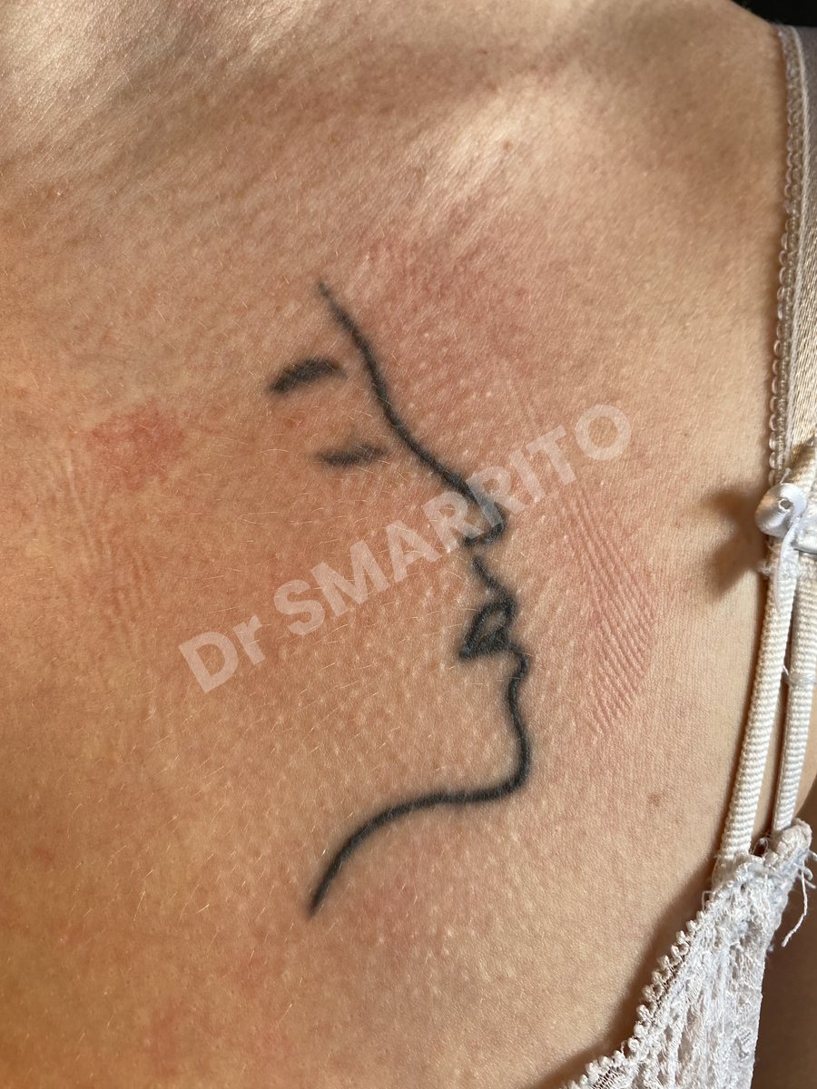 Détatouage laser avant : encre noire, trait unique d'épaisseur moyenne, Dr Smarrito, chirurgie esthétique et laser à Vevey