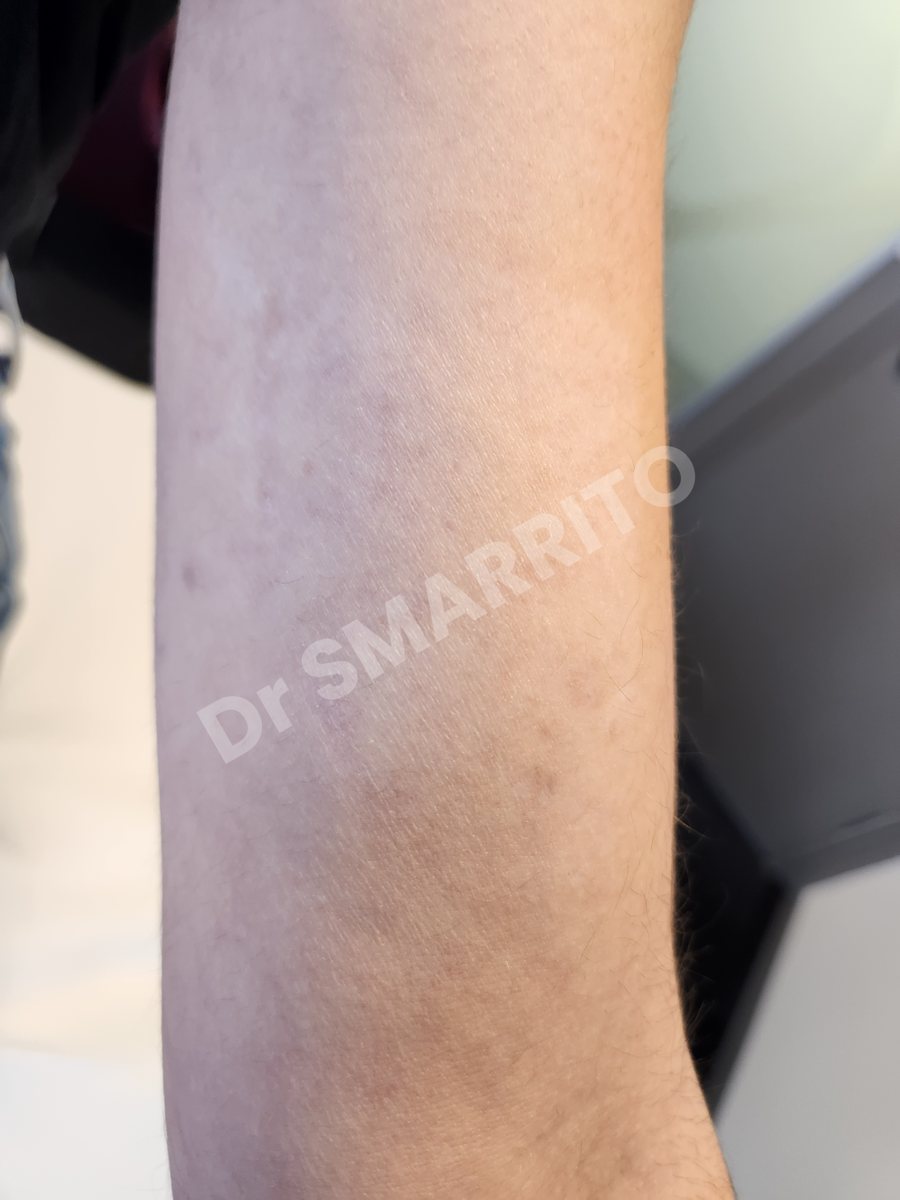 Détatouage laser après : encre noire, traits et ombrages, densité moyenne, Dr Smarrito, chirurgie esthétique et laser à Vevey