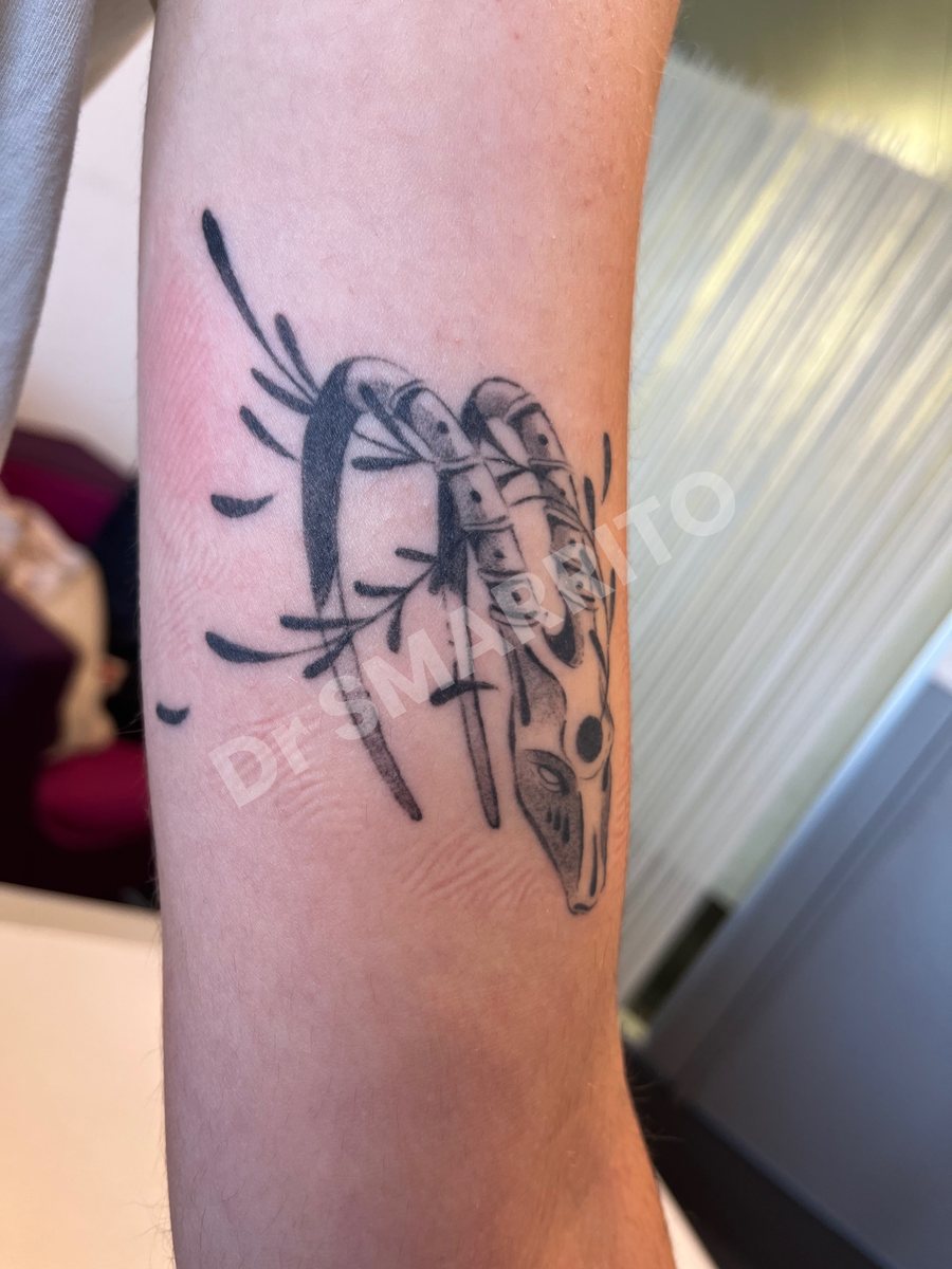 Détatouage laser avant : encre noire, traits et ombrages, densité moyenne, Dr Smarrito, chirurgie esthétique et laser à Vevey