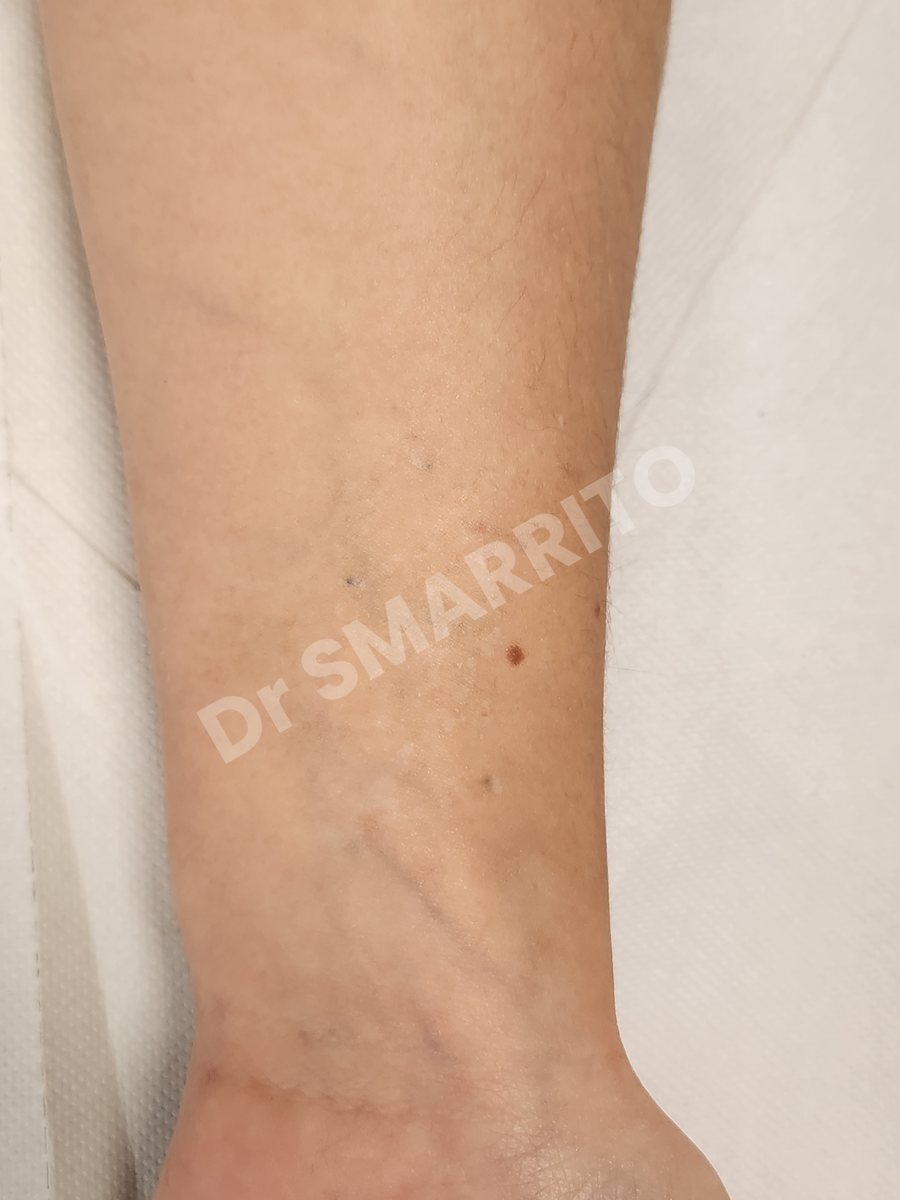 Détatouage laser après : encre noire, trait épais, Dr Smarrito, chirurgie esthétique et laser à Vevey