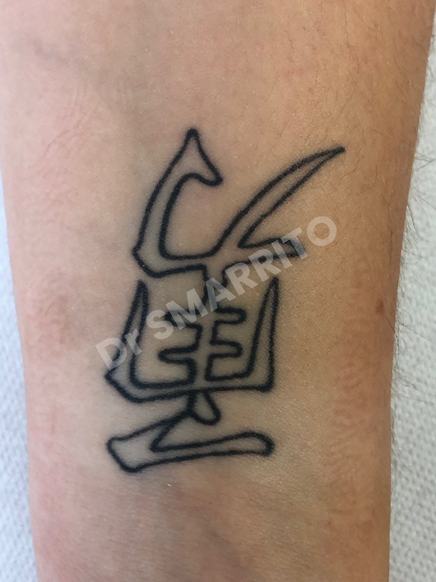 Détatouage laser avant : encre noire, trait épais, Dr Smarrito, chirurgie esthétique et laser à Vevey