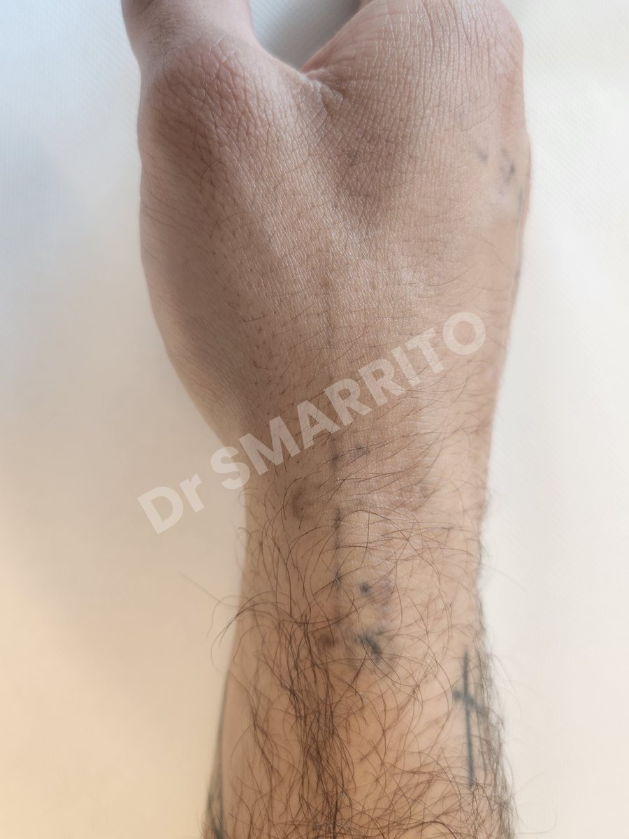 Détatouage laser après : encre noire, trait moyen et ombrages, Dr Smarrito, chirurgie esthétique et laser à Vevey
