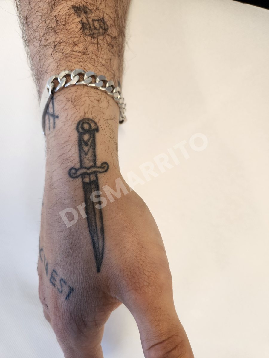 Détatouage laser avant : encre noire, trait moyen et ombrages, Dr Smarrito, chirurgie esthétique et laser à Vevey