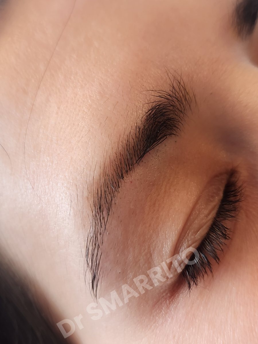 Détatouage laser après : pigment rouge, trait fin de maquillage permanent, Dr Smarrito, chirurgie esthétique et laser à Vevey