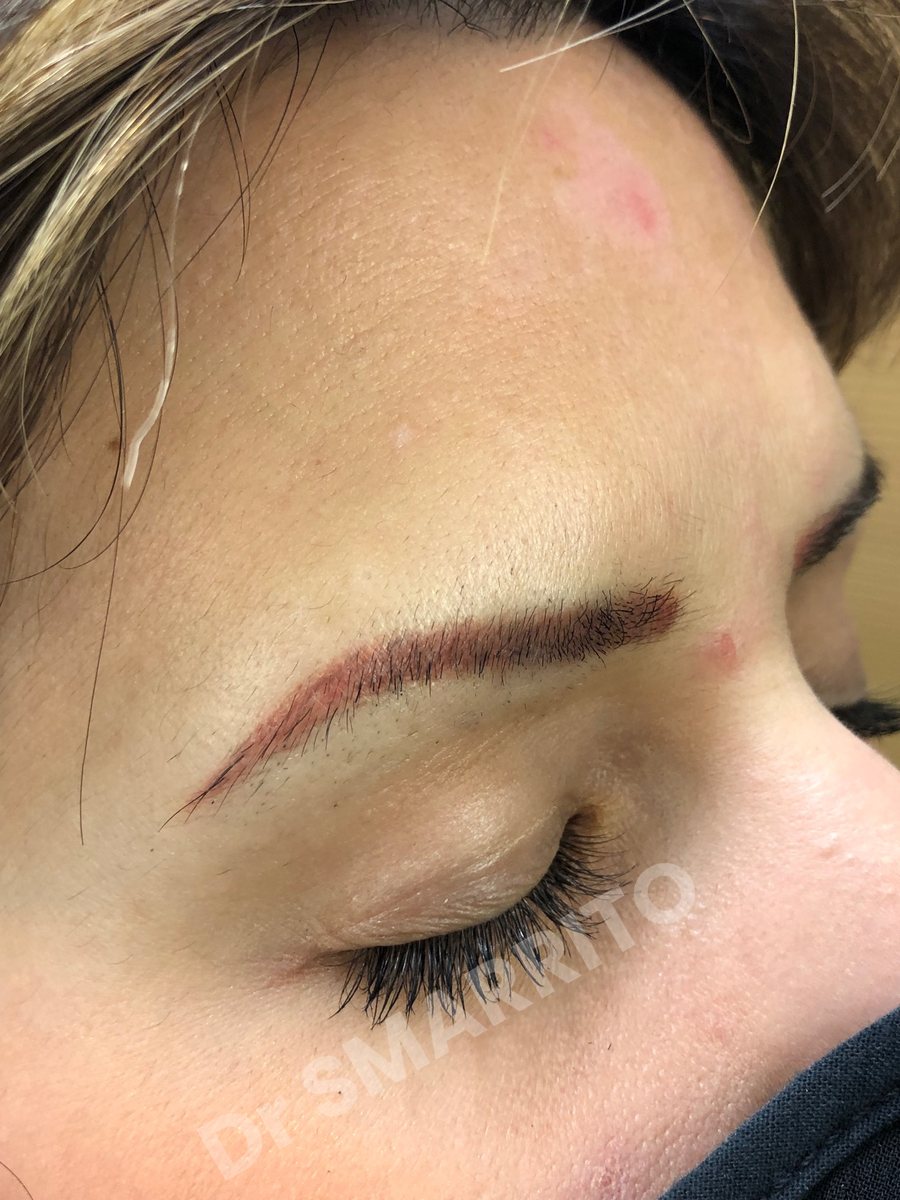 Détatouage laser avant : pigment rouge, trait fin de maquillage permanent, Dr Smarrito, chirurgie esthétique et laser à Vevey