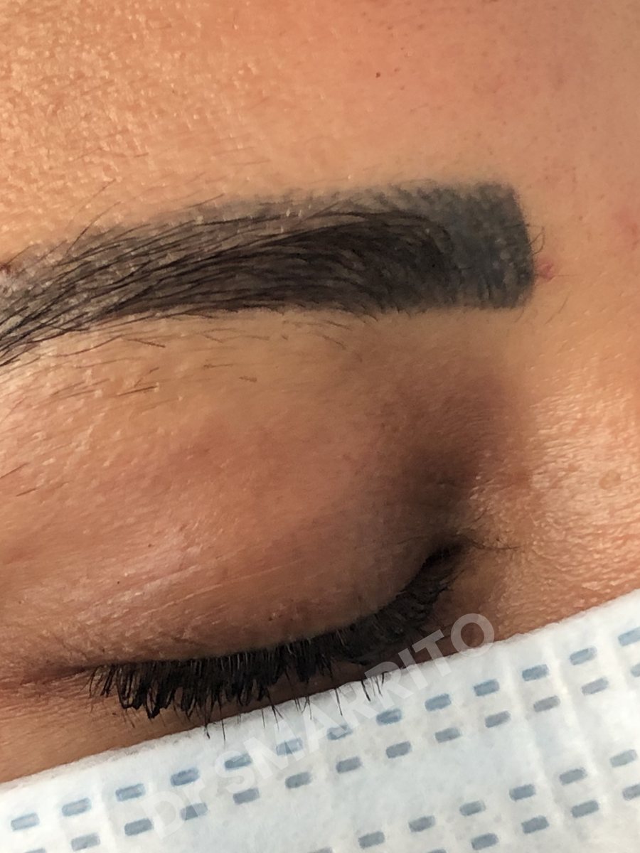 Détatouage laser avant : pigment noir dense, maquillage permanent saturé, Dr Smarrito, chirurgie esthétique et laser à Vevey