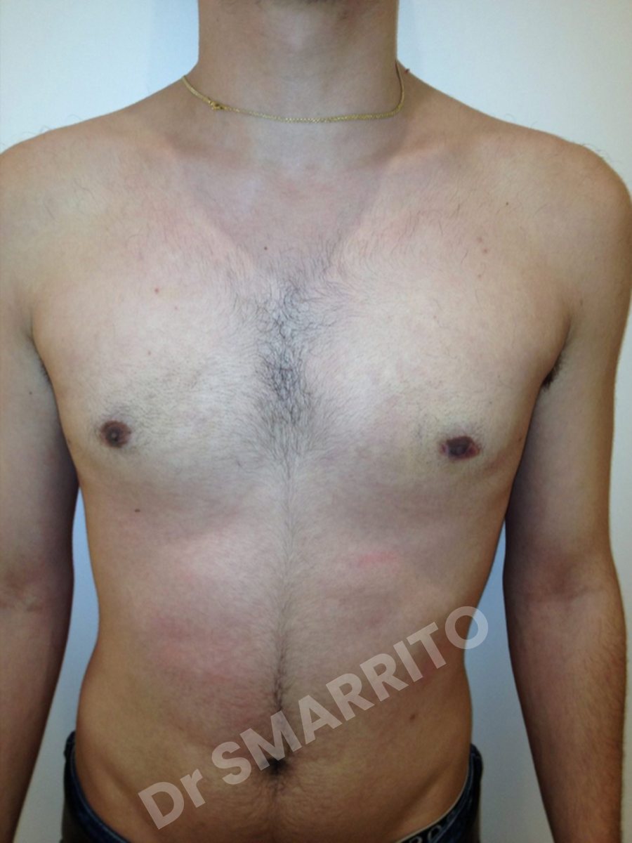 Gynécomastie après : torse, vue de face, Dr Smarrito, chirurgie esthétique à Vevey