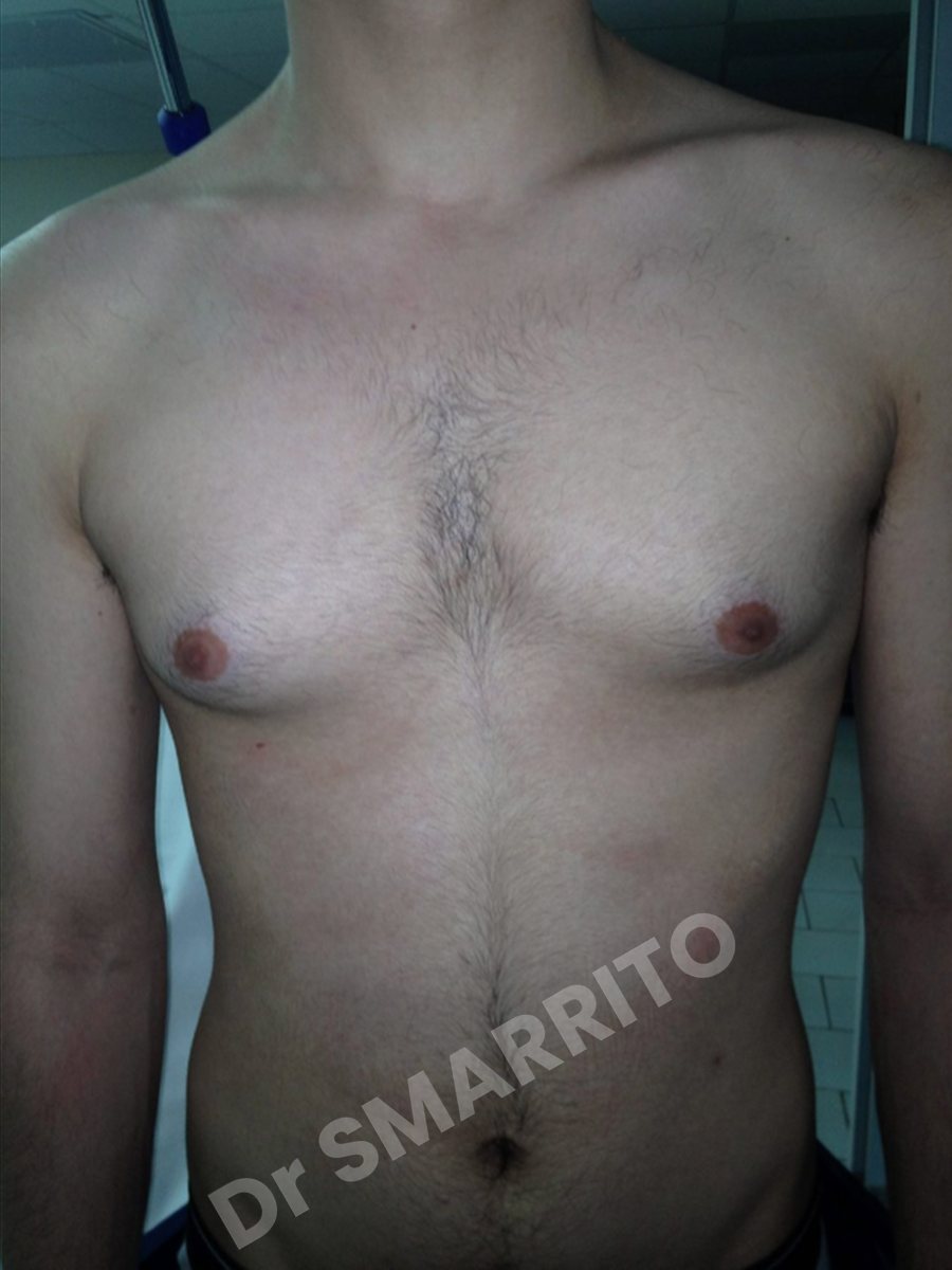 Gynécomastie avant : torse, vue de face, Dr Smarrito, chirurgie esthétique à Vevey