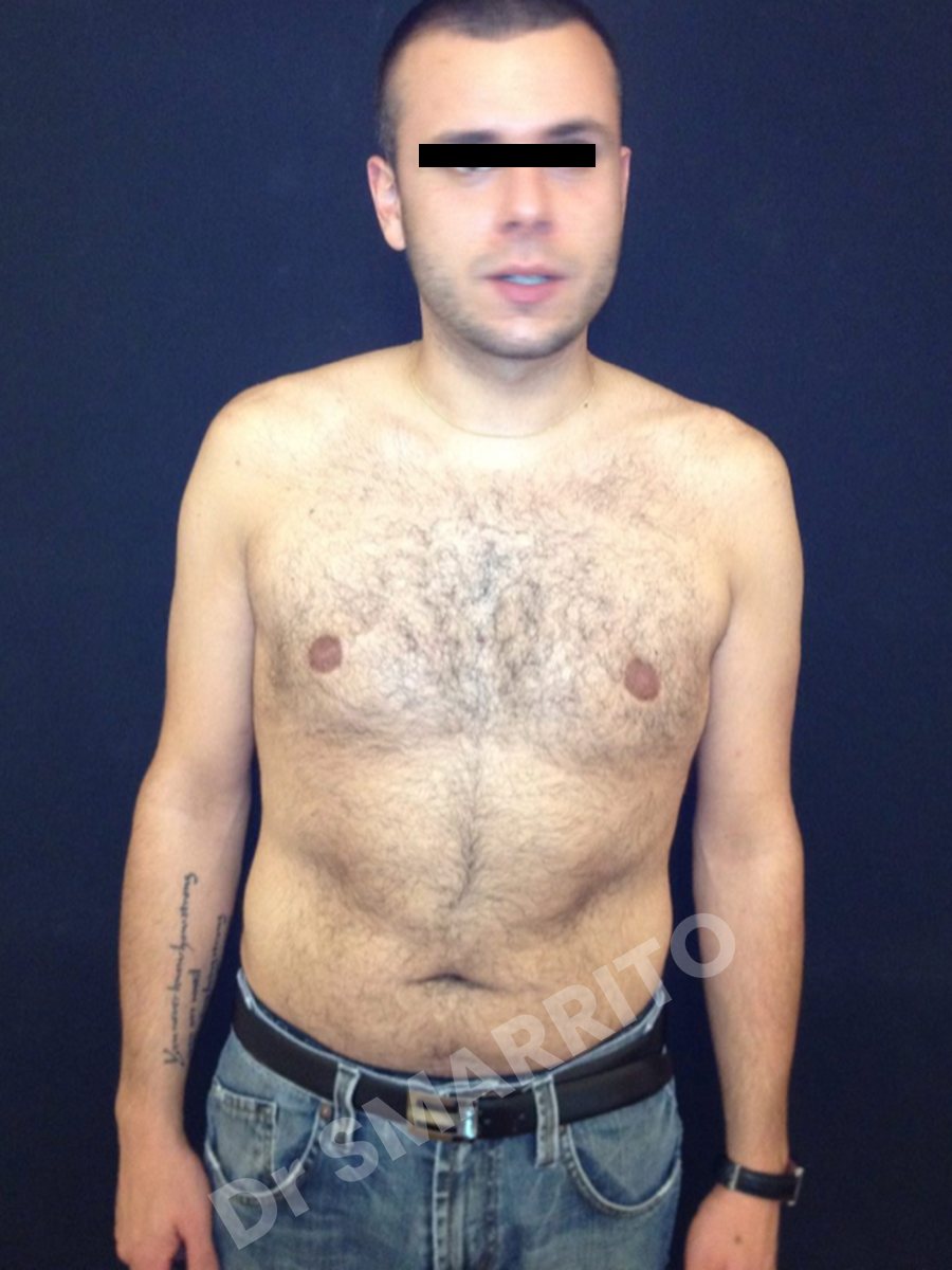 Gynécomastie après : torse, vue de face, Dr Smarrito, chirurgie esthétique à Vevey
