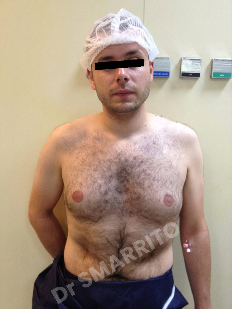Gynécomastie avant : torse, vue de face, Dr Smarrito, chirurgie esthétique à Vevey