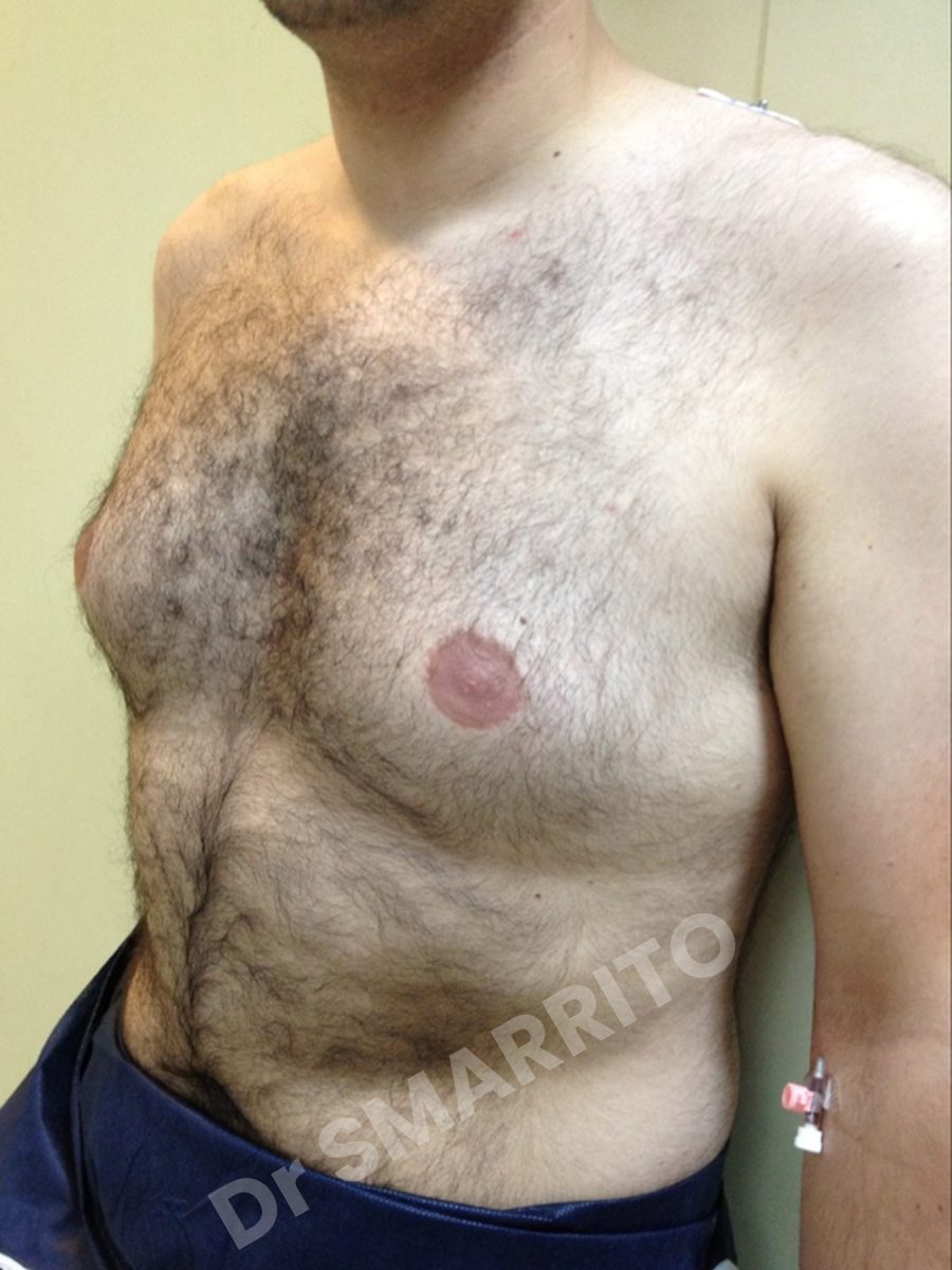 Gynécomastie avant : torse, vue de trois-quarts, Dr Smarrito, chirurgie esthétique à Vevey